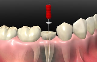 根管治療