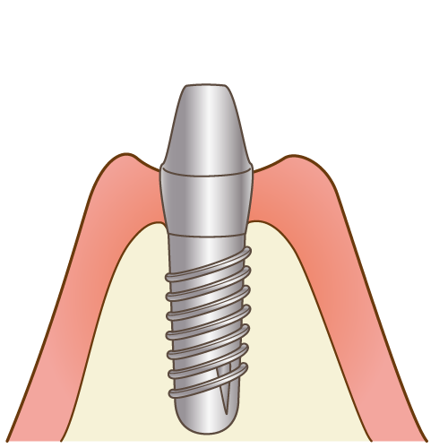 第一回目のインプラント手術