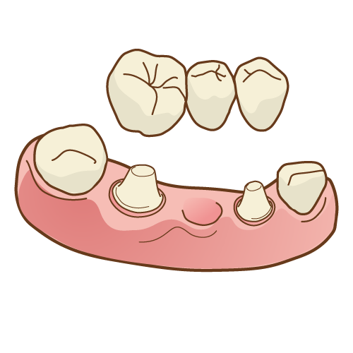 入れ歯のメリットデメリット1|京都市右京区のデンタルクリニック川村