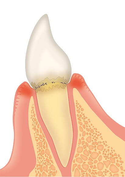 歯肉炎|歯周病