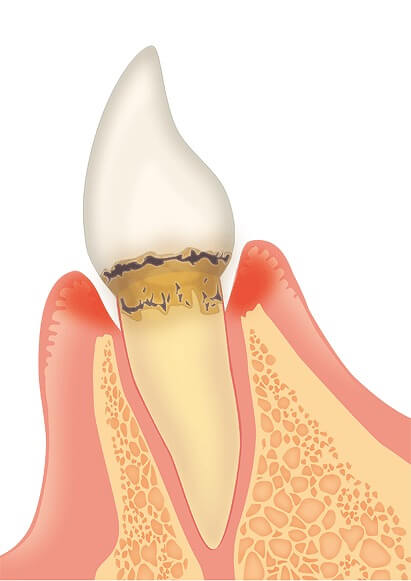 軽度歯周炎|歯周病