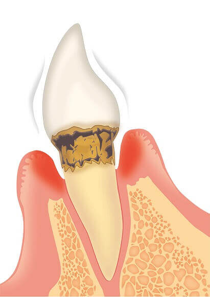 中等度歯周炎|歯周病