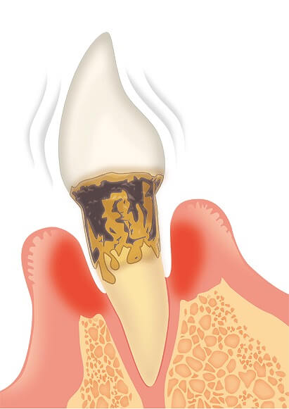 重度歯周炎|歯周病