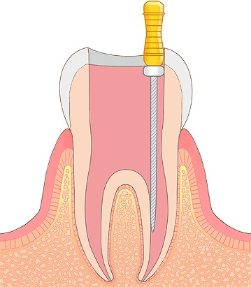 根管治療1