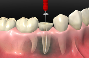 根管治療