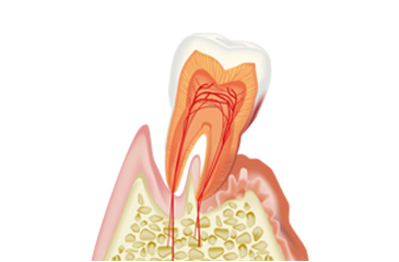 歯周病治療