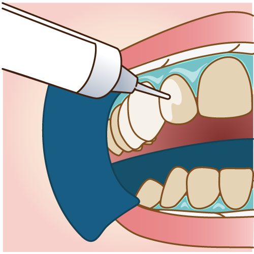 ホワイトニングの薬剤をつけています