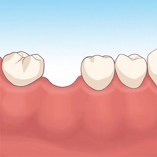 奥歯の脱落により前歯に隙間が空いてきた