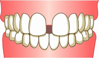 前歯に隙間が空いてきた原因とは